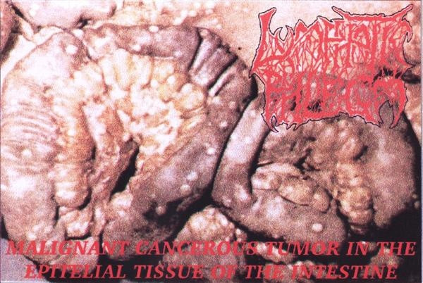 Malignant Cancerous Tumor in the Epitelial Tissue of the Intestine Cover